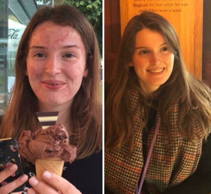 2015 vs. 2017 My Skin Has Been Better For A While (Shout Out To The Pill) But Seeing This Old Photo Compared To A New One (Where I’m Not Even Wearing Make Up) Made Me So Happy I Just Had To Share It Somewhere!!