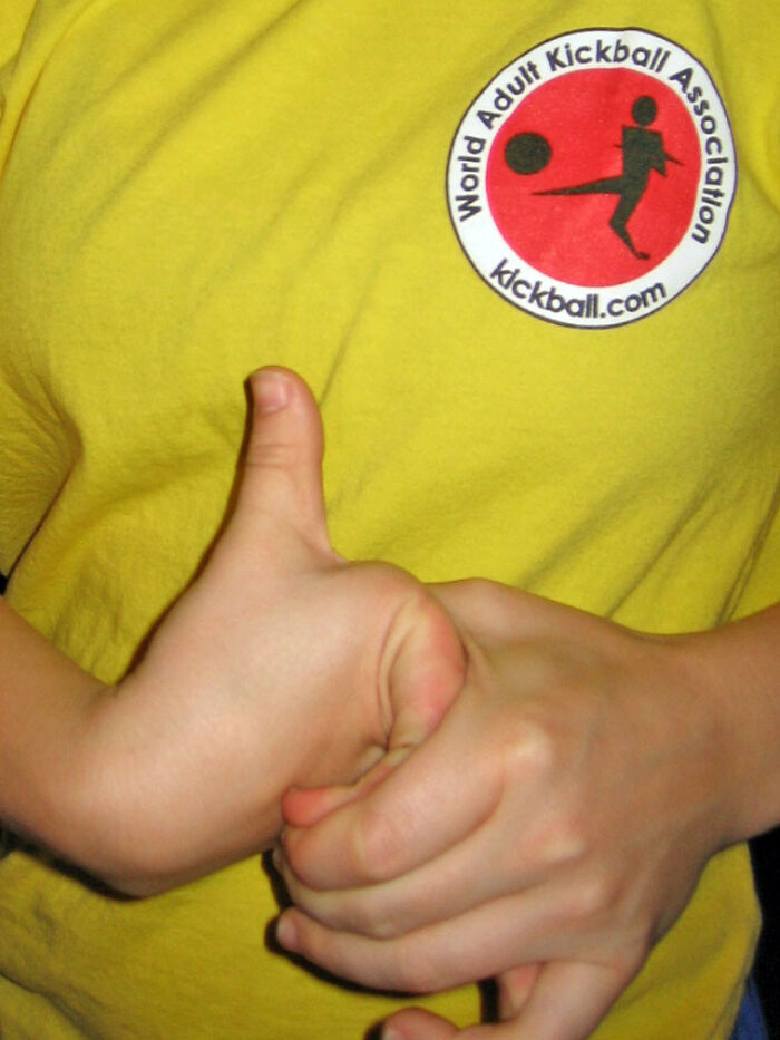 Only People With Rare Body Features Joined This Thread And Shared 35 Of Their Body Anomalies - 23