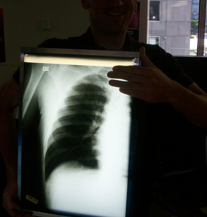 Only People With Rare Body Features Joined This Thread And Shared 35 Of Their Body Anomalies - 25