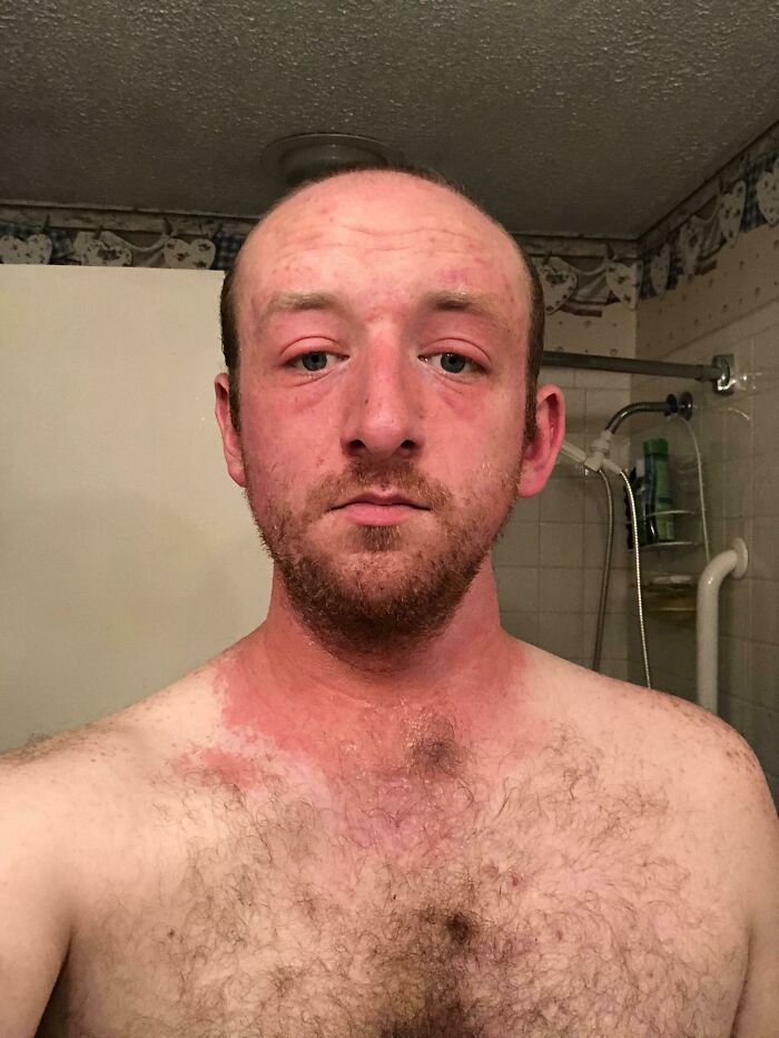 Came Home For A Week To Help My Parents Out With Some Yard Work. Turns Out, I Don’t Know What Poison Ivy Looks Like