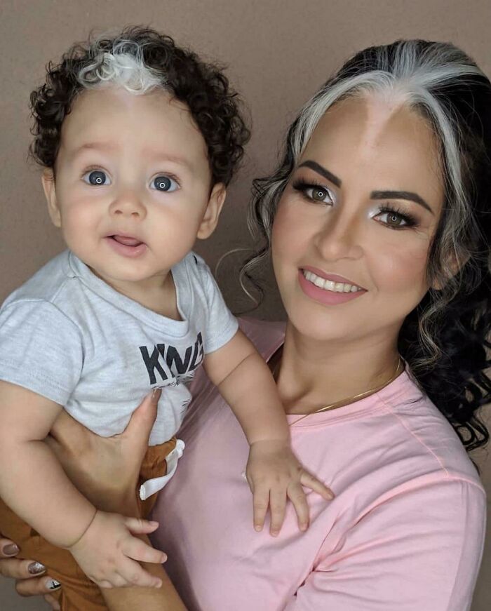 Mother And Child With Poliosis