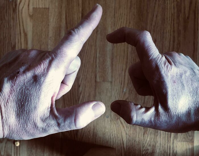 I Have The Linburg-Comstock Variant In My Right Hand: I Can’t Flex My Thumb Without My Index Finger Flexing Too. About One In Five People Are Like Me