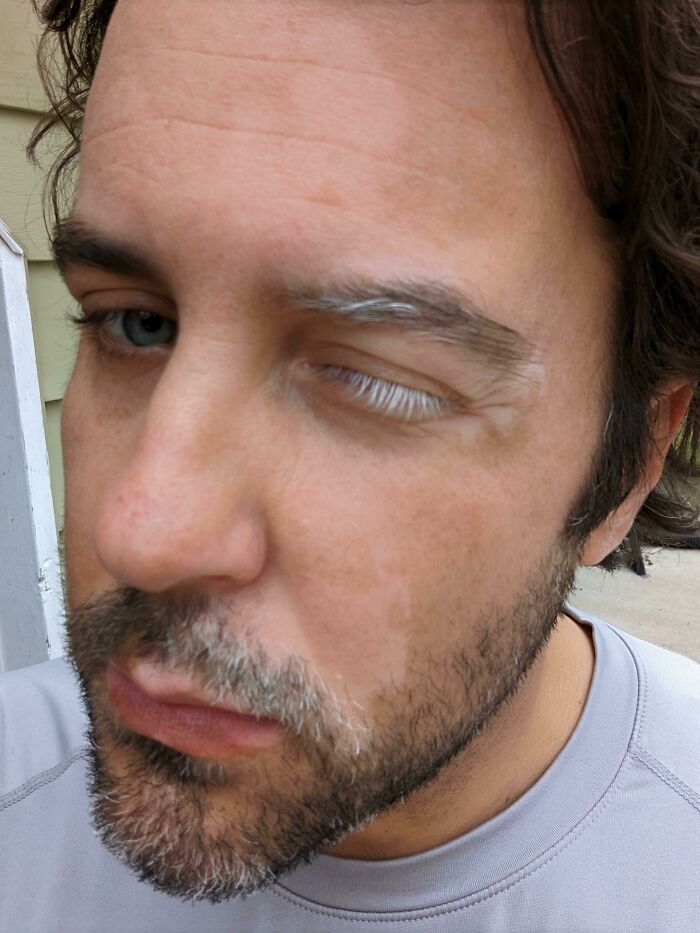 Where's My White Lash Enjoyers At? Just Wanted To Remind Everyone We Are Beautiful Because/Despite Our Vitiligo