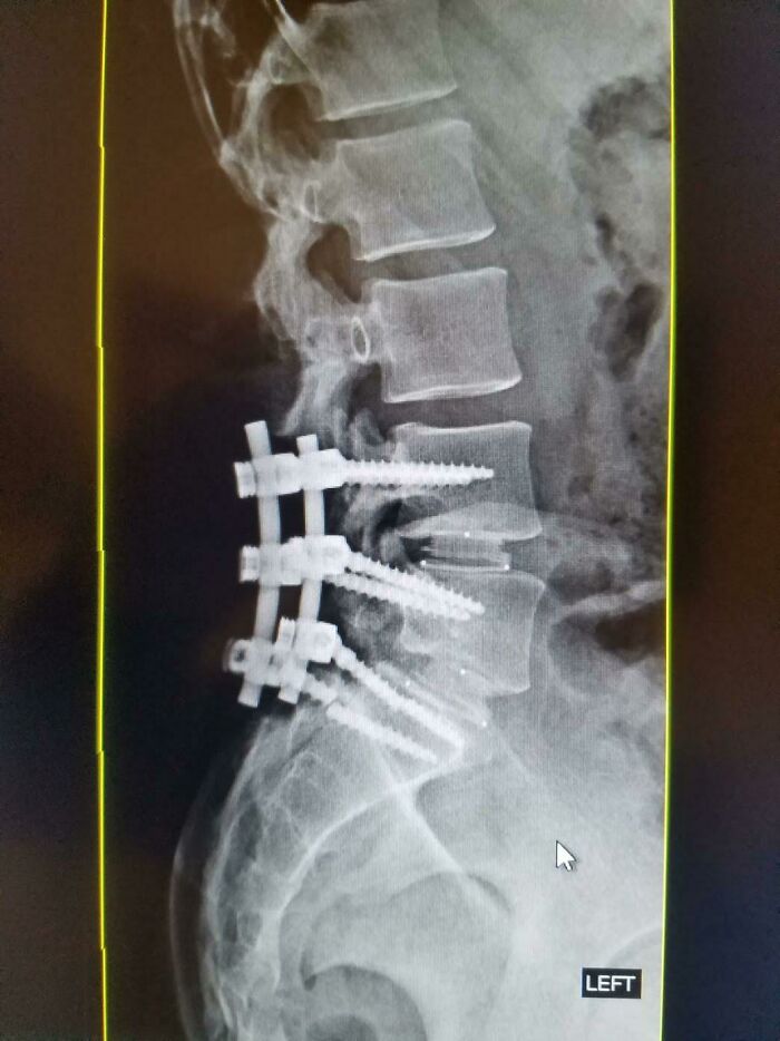 That Time I Broke One Of The Screws In My Back