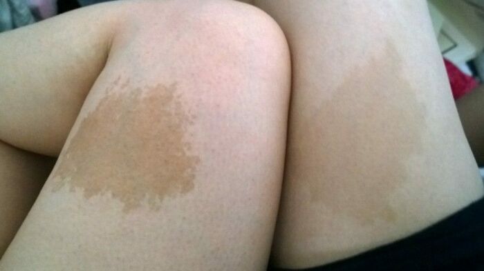 When I Met My Wife, We Didn't Know At The Time But It Turns Out That We Have Similar Looking Birthmarks On Our Thighs