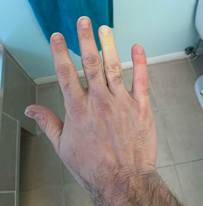My Right Hand’s Ring Finger Becomes Colorless And Numb When It’s Cold Outside. I’m Living In Icy Canada