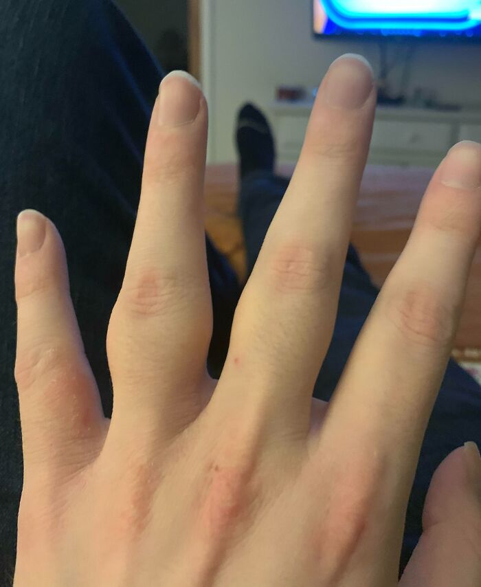 My Knuckles Of My Ring Fingers Are Unnaturally Large
