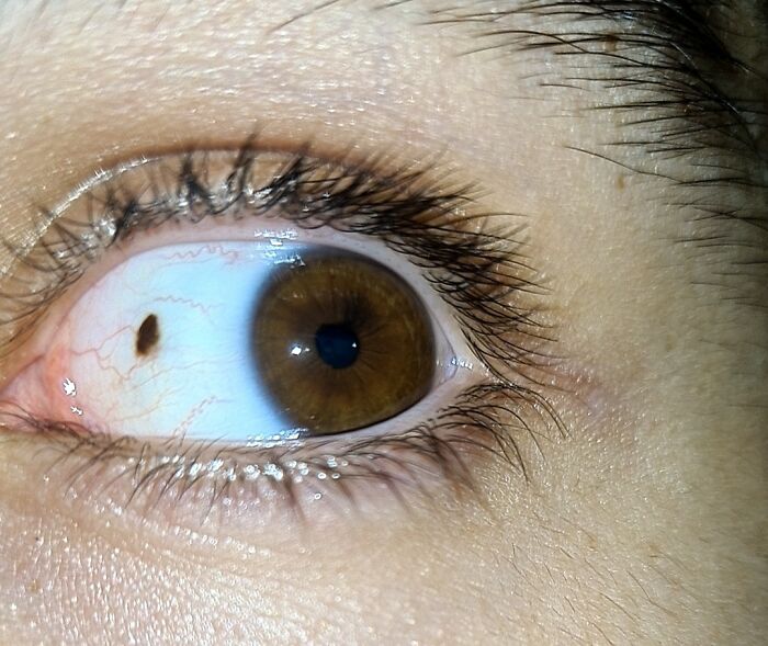 I Have A Freckle On My Eye