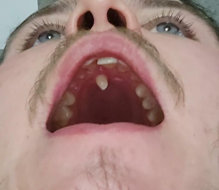 I Have An Extra Tooth On The Roof Of My Mouth