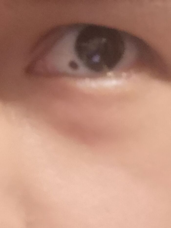 Only People With Rare Body Features Joined This Thread And Shared 35 Of Their Body Anomalies - 5