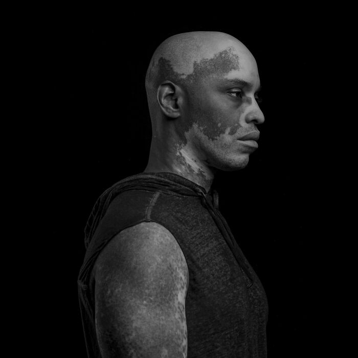 Powerful black and white portrait of a man with vitiligo wearing a sleeveless hoodie against a dark background.
