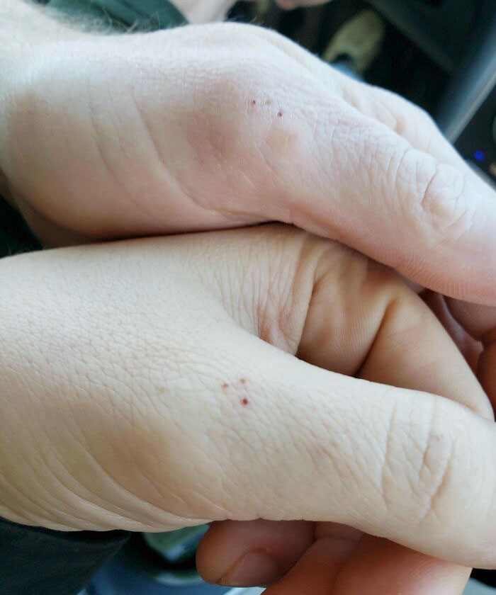 My Wife And I Have The Same 3 Dots In The Same Place On Our Thumb