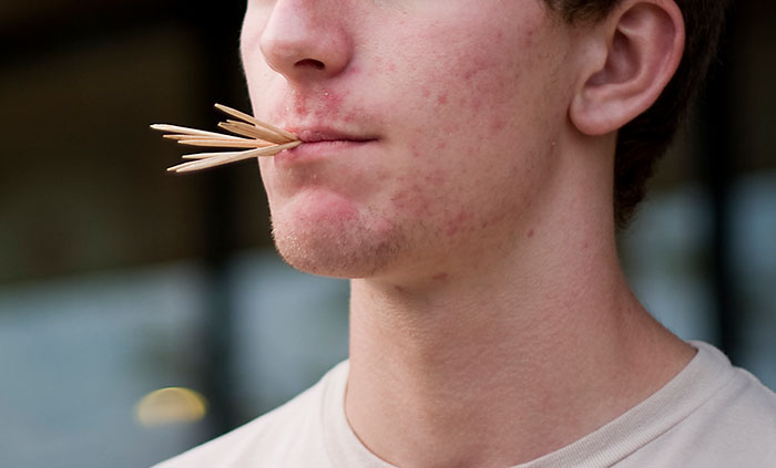 Young man with acne holding multiple toothpicks in his mouth, illustrating disturbing and disgusting things doctors witness at work.