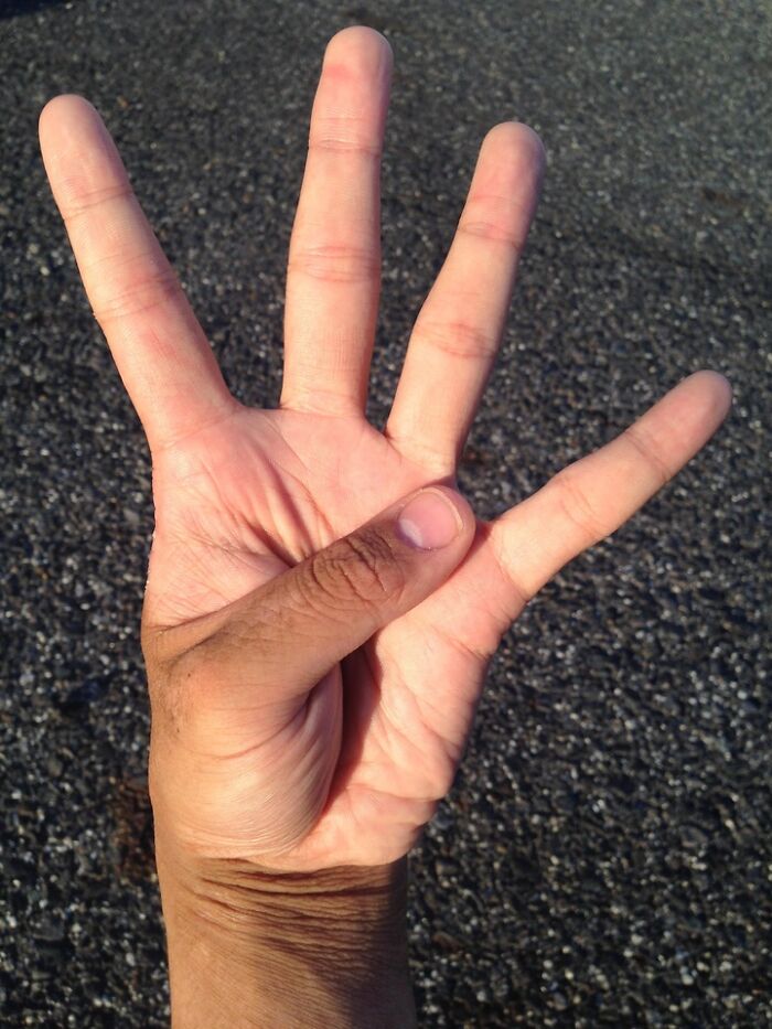 Only People With Rare Body Features Joined This Thread And Shared 35 Of Their Body Anomalies - 24