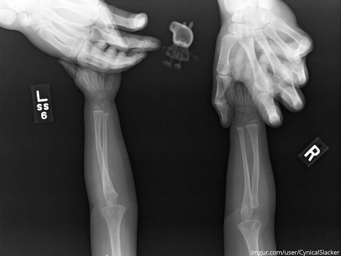 "Daughter Demanded Peppa Pig Get The X-Ray With Her"