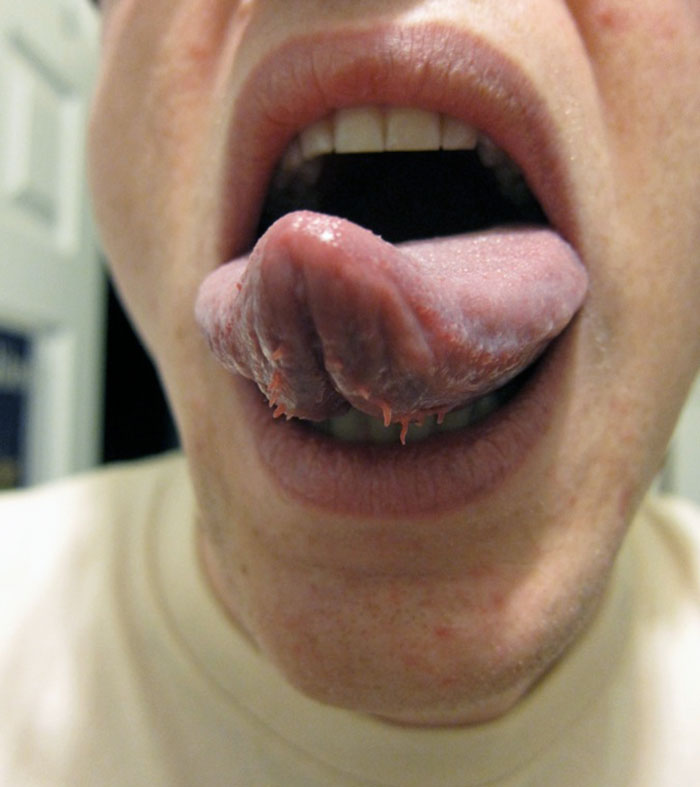 A Little-Known Monstrosity That Many Of You Have: The Plica Fimbriata