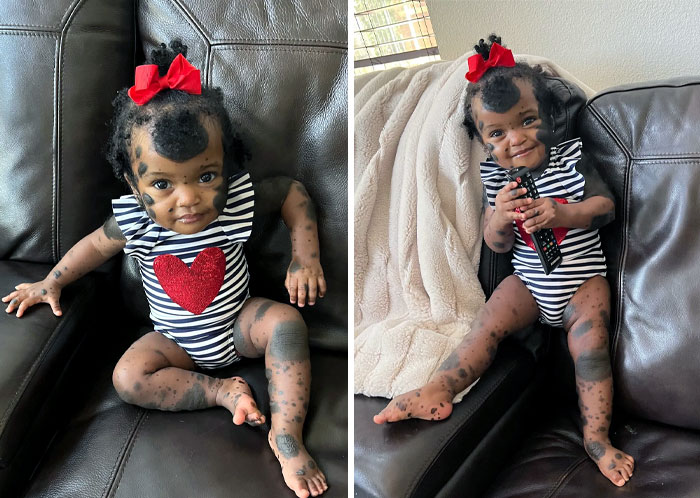 Congenital Melanocytic Nevus Is Visible Pigmented Spots On The Skin Present At Birth. They Usually Are Brown, Tan, Pink, Or Black. Some Moles Produce Dark, Coarse Hair