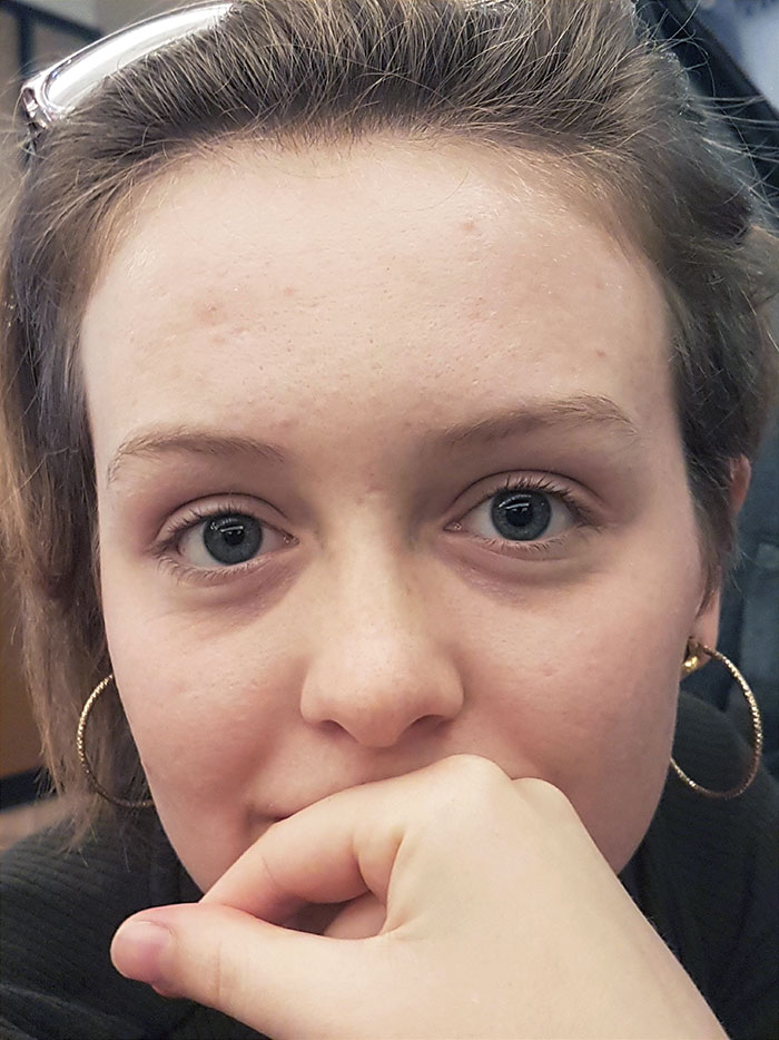 I Just Wanted To Showcase My Anisocoria. My Pupils Are Different Sizes And Switch Often