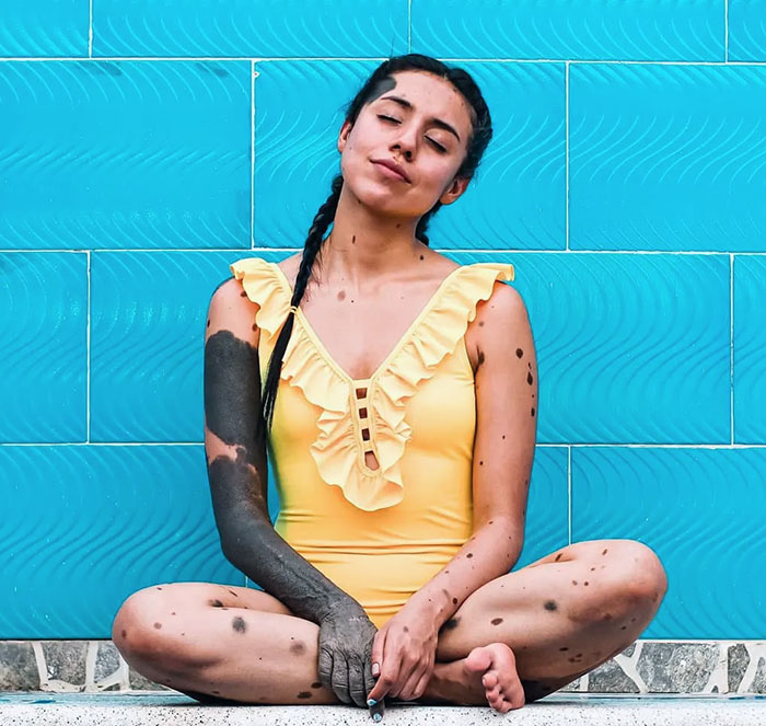 Congenital Melanocytic Nevus. It Appears As A Circumscribed, Light Brown To Black Patch, Covering Any Size Surface Area And Any Part Of The Body