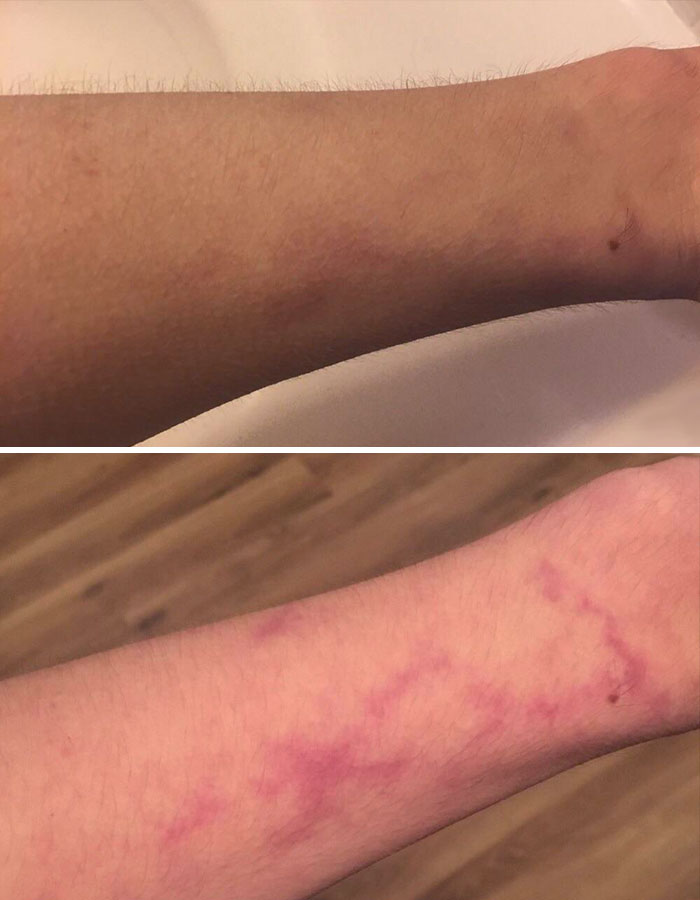 My Birthmark Becomes More Visible The Colder I Am