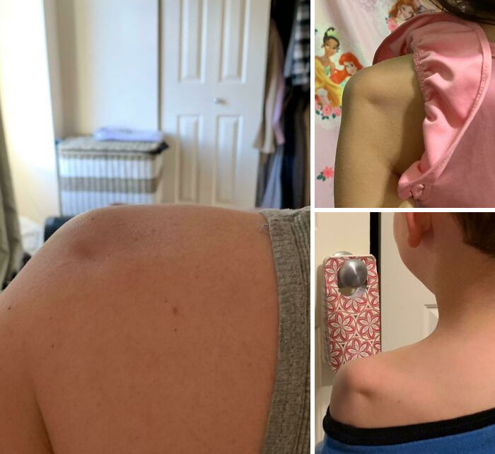 My Husband And Both Our Kids Have These Shoulder Dimples