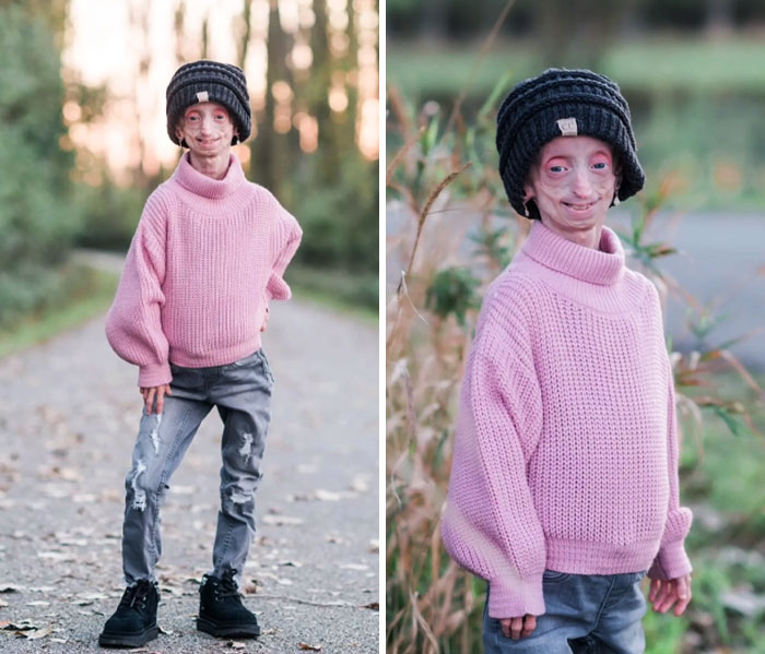 Hutchinson-Gilford Syndrome Causes Individuals To Age Faster Than Usual And Makes Them Appear Older Than They Actually Are