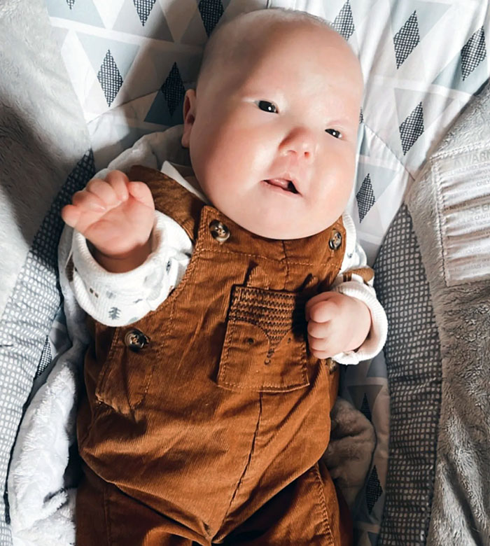 Pierre Robin Syndrome Is Characterized By An Underdeveloped Jaw, Backward Displacement Of The Tongue, And Upper Airway Obstruction