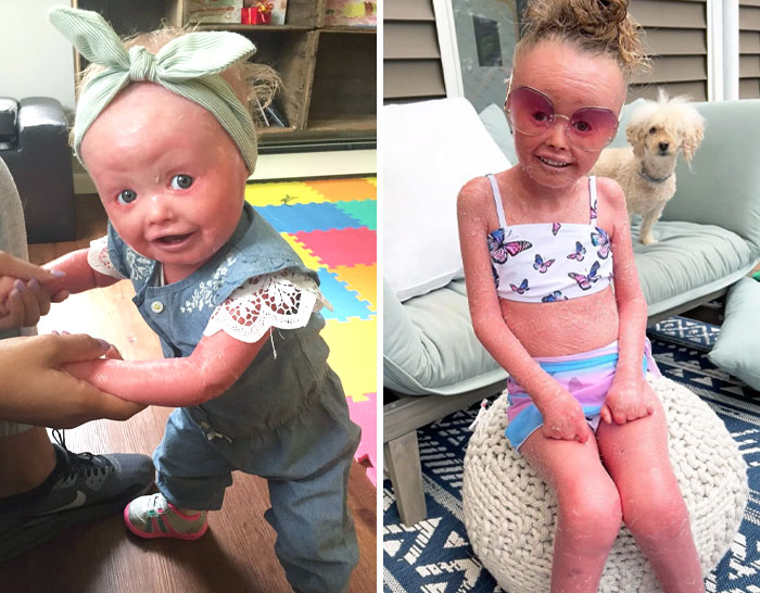 Ichthyosis Vulgaris Is An Inherited Skin Disorder In Which Dead Skin Cells Accumulate In Thick, Dry Scales On Your Skin's Surface