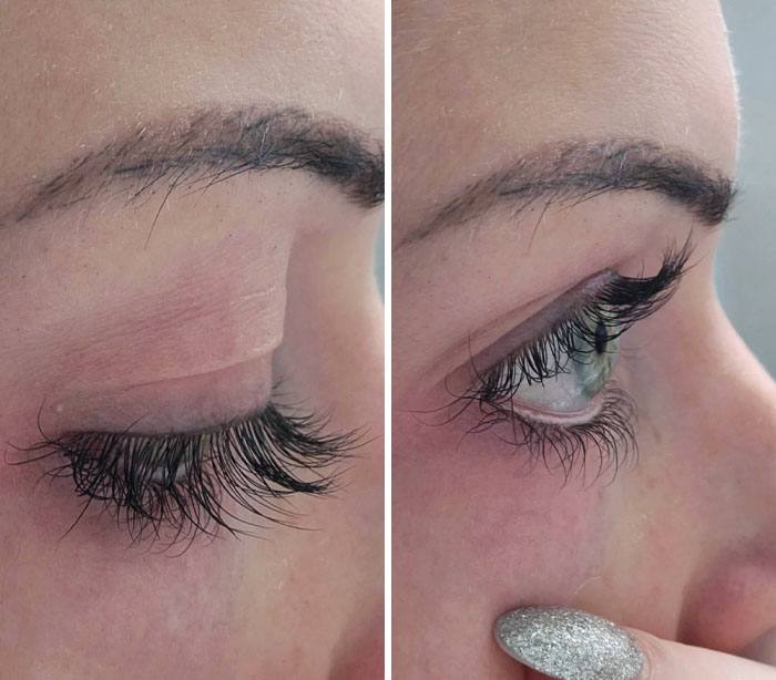 I Have Distichiasis. It Is A Rare Genetic Mutation That Causes Heart Problems, Sight Problems, And So On