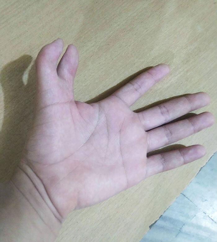 I Have Two Thumbs On My Left Hand. What Do You Have?