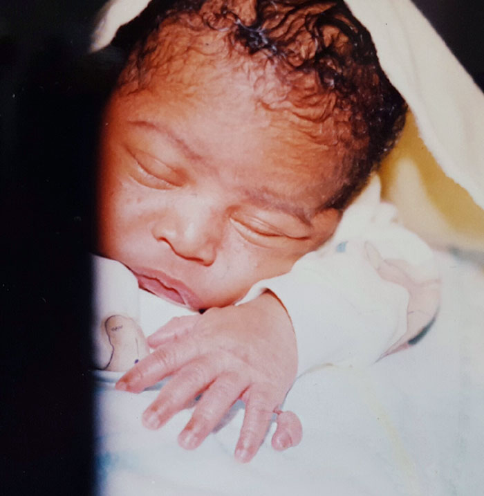 I Was Born With 12 Fingers, Amputated At Birth