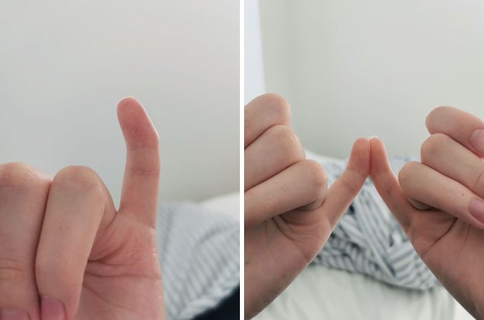 Due To Genetics, My Last Pinky Joint Is Pointing Inwards. Doctor Said Either I Stay Like This With Pain, Or He Breaks My Bones And Hopes I Have A Little Feeling Left After Healing