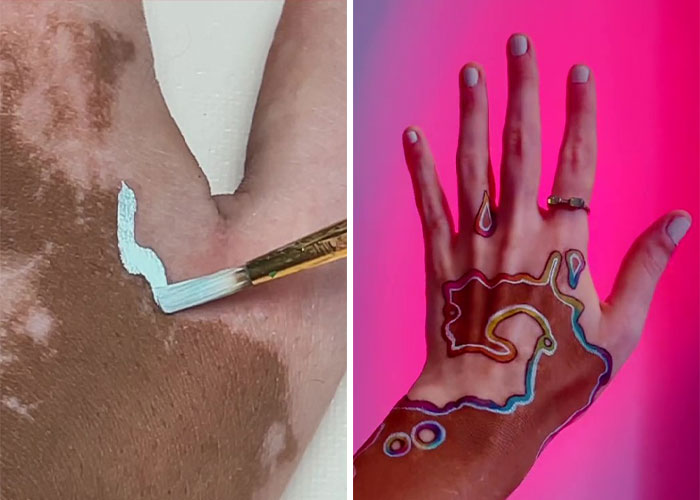Woman Matches The Color Of The Paint She Outlines Her Vitiligo Spots With To Her Outfits, And People Can’t Get Enough Woman Matches The Color Of The Paint She Outlines Her Vitiligo Spots With To Her Outfits, And People Can’t Get Enough