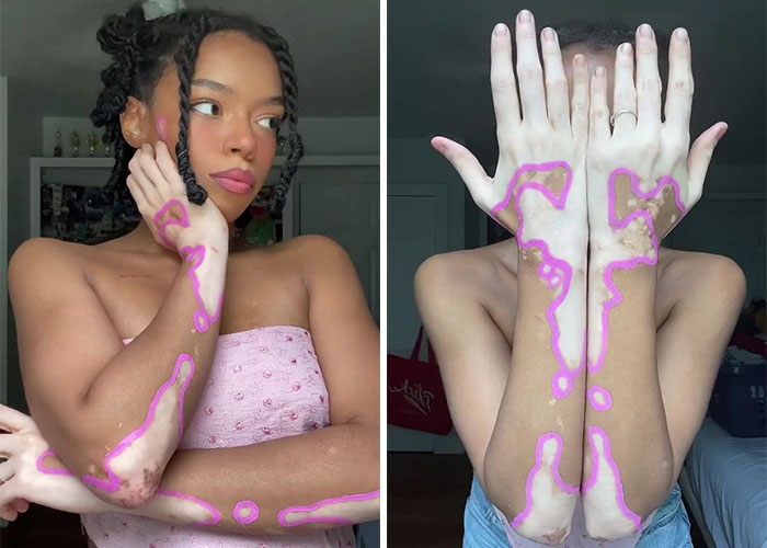 Woman Matches The Color Of The Paint She Outlines Her Vitiligo Spots With To Her Outfits, And People Can’t Get Enough Woman Matches The Color Of The Paint She Outlines Her Vitiligo Spots With To Her Outfits, And People Can’t Get Enough