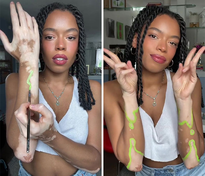 Woman Matches The Color Of The Paint She Outlines Her Vitiligo Spots With To Her Outfits, And People Can’t Get Enough Woman Matches The Color Of The Paint She Outlines Her Vitiligo Spots With To Her Outfits, And People Can’t Get Enough