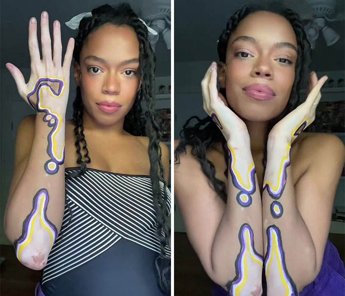 Woman Matches The Color Of The Paint She Outlines Her Vitiligo Spots With To Her Outfits, And People Can’t Get Enough Woman Matches The Color Of The Paint She Outlines Her Vitiligo Spots With To Her Outfits, And People Can’t Get Enough