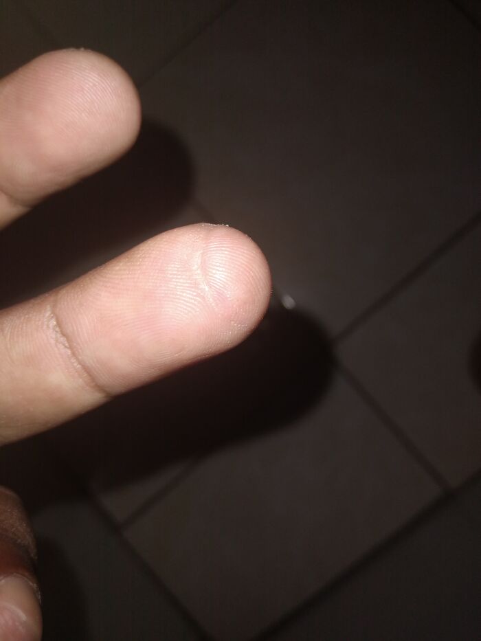 My Left Ring Finger. Probably 8, Cutting A Papaya. Using My Hand As A Cutting Board