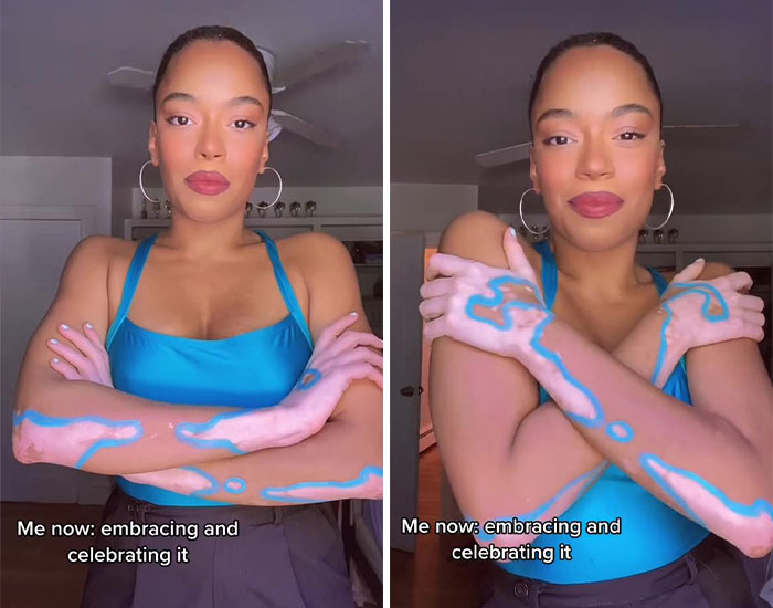 Woman Matches The Color Of The Paint She Outlines Her Vitiligo Spots With To Her Outfits, And People Can’t Get Enough Woman Matches The Color Of The Paint She Outlines Her Vitiligo Spots With To Her Outfits, And People Can’t Get Enough