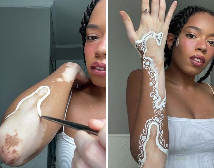 Woman Matches The Color Of The Paint She Outlines Her Vitiligo Spots With To Her Outfits, And People Can’t Get Enough Woman Matches The Color Of The Paint She Outlines Her Vitiligo Spots With To Her Outfits, And People Can’t Get Enough