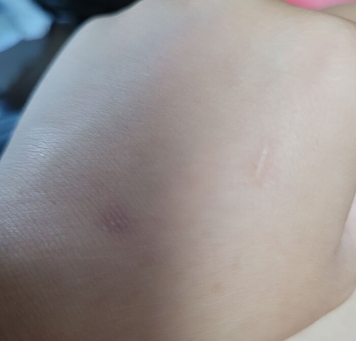 The Bottom One Is When I Tore Open A Mosquito Bite That Was Bugging Be, And The Top Was Made With A Pencil. Only It Was A Dull Pencil That I Rubbed Against My Hand 