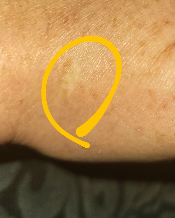 Teenage Me Had A Hive And Decided That The Best Way To Stop The Itching Was To Cut Out The Hive