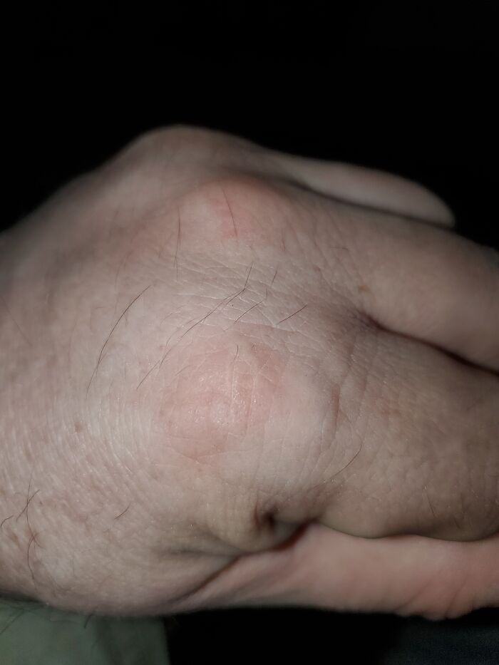 Forty-Odd Years Ago, A Branch I Was Trying To Cut Was Too Bouncy, So I Grabbed On To Steady It. Then The Chainsaw Bounced Off The Branch And Onto My Knuckle