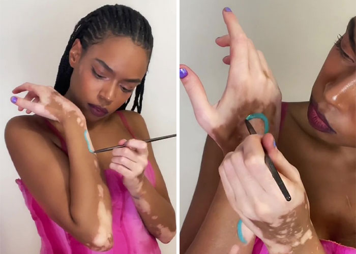 Woman Matches The Color Of The Paint She Outlines Her Vitiligo Spots With To Her Outfits, And People Can’t Get Enough Woman Matches The Color Of The Paint She Outlines Her Vitiligo Spots With To Her Outfits, And People Can’t Get Enough