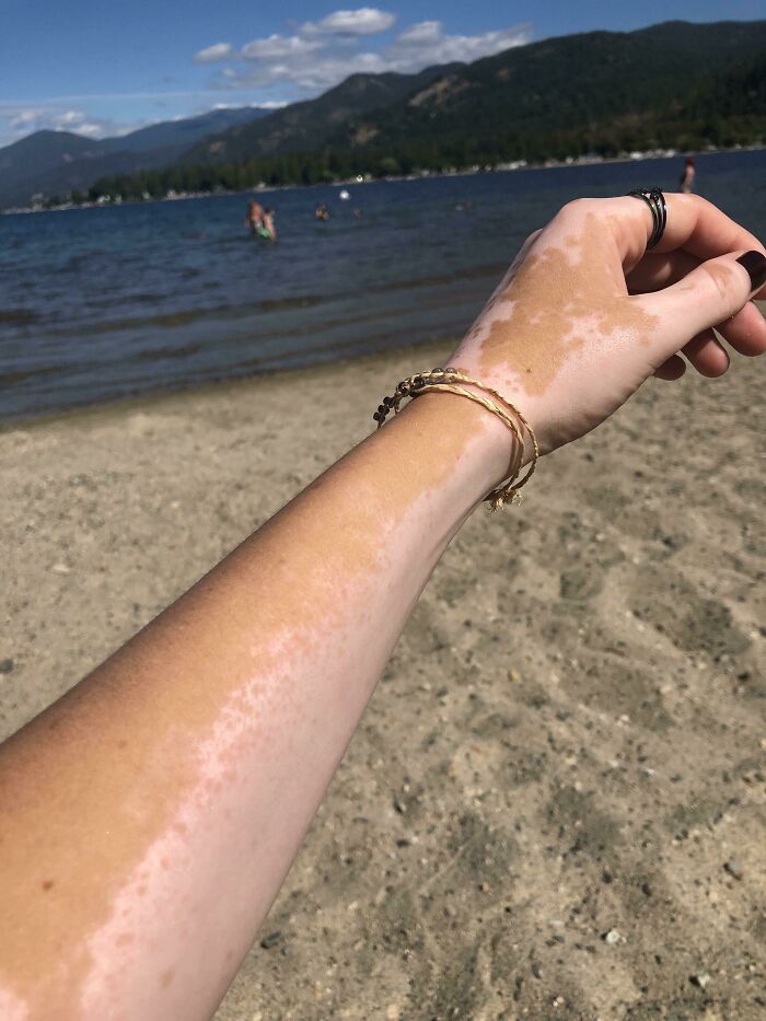 The Way My Skin Tries To Re-Pigment In The Summer (All Of The Little Dots Are New Pigment)