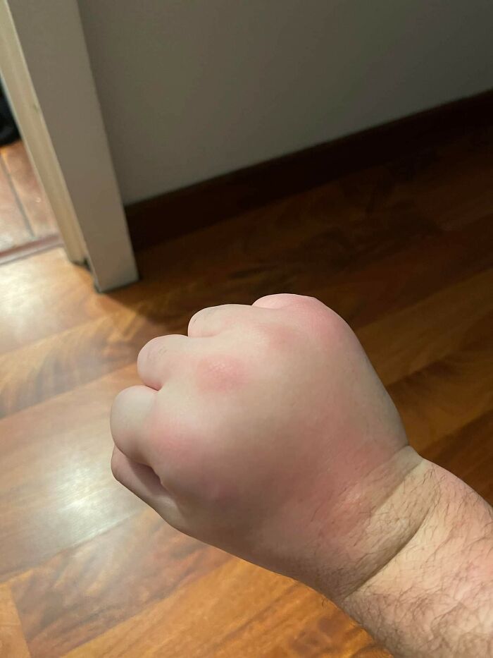 My Friend Got Stung By Something