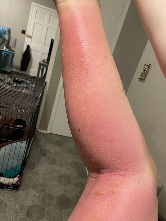 I Forgot That I Don’t Have An Ounce Of Melanin In My Skin And I Fell Asleep On The Beach For 4 Hours