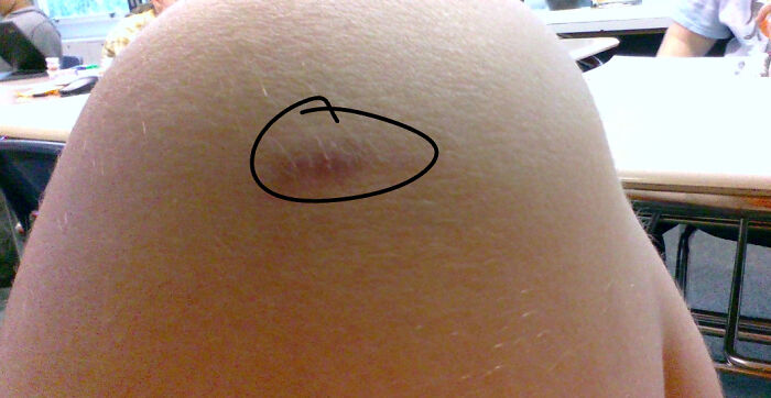 I Was Climbing A Dead Tree And The Branch I Was Standing On Broke Under My Foot And Cut My Leg As I Fell