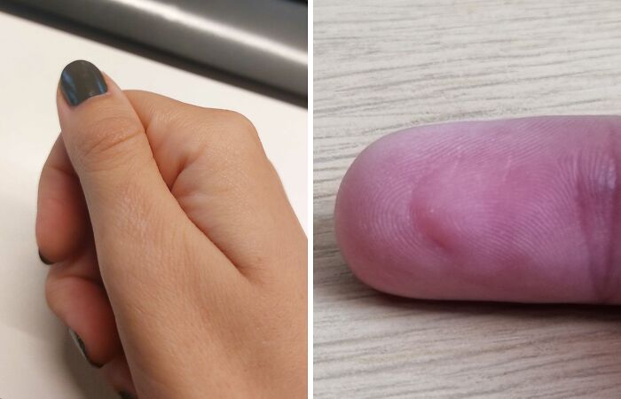 Hey Pandas, What Is Your Dumbest Scar And How Did You Get It? (Closed)