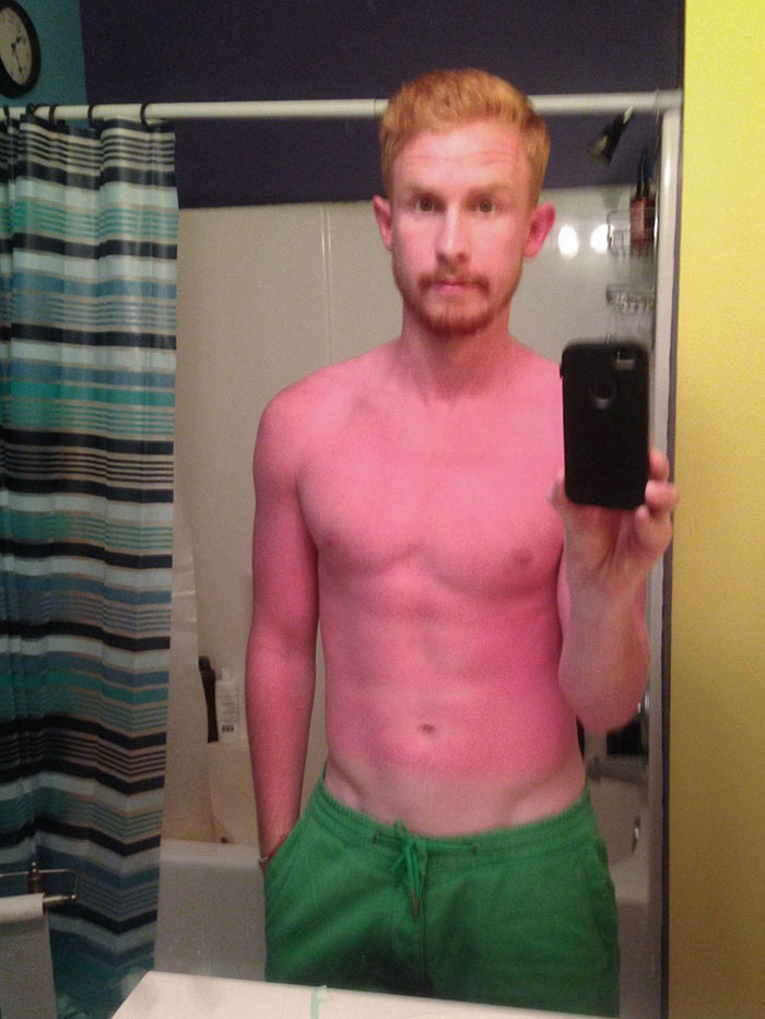 What Could Go Wrong If I Forget Sunscreen