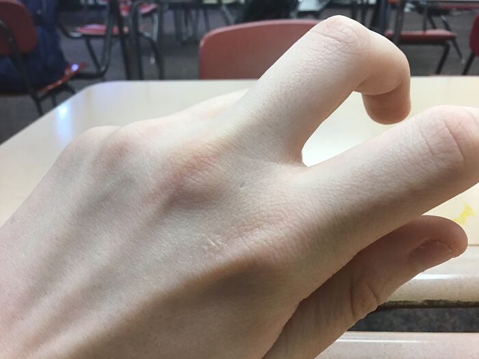 That Tiny Pit, I Had A Small Wart That I Picked Off With A Needle